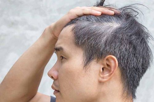 7 nguyên nhân khiến người trẻ có tóc bạc