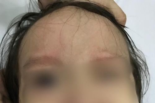 Bé gái 17 tháng tuổi đột ngột liệt mặt sau khi chảy mũi, ngạt mũi
