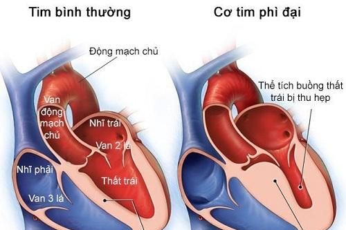 Loại thuốc mới có thể giúp cải thiện chức năng tim