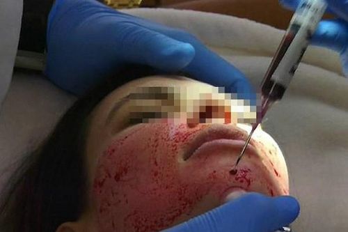 Cơn 'sốt' làm đẹp da bằng… máu tự thân, coi chừng tiền mất tật mang