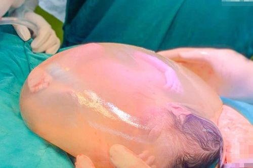 Bé gái nằm trong bọc ối khi chào đời