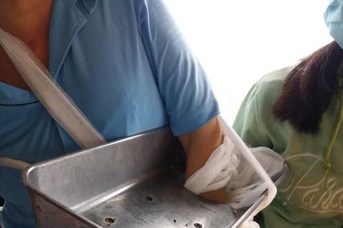 Người phụ nữ bị nghiền nát bàn tay trong lúc vệ sinh máy xay thịt