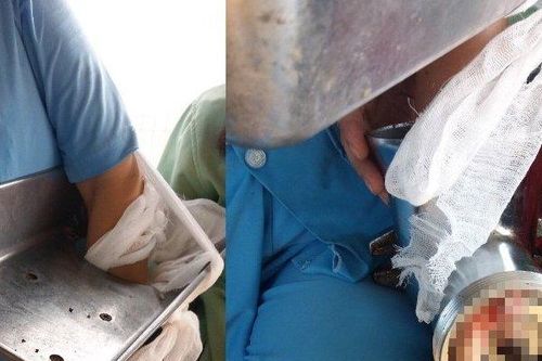 Vệ sinh máy xay thịt, người phụ nữ bị nghiền nát bàn tay