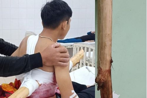 Sau 3 ca phẫu thuật, thanh niên bị khúc cây đâm xuyên ngực đã qua cơn nguy kịch