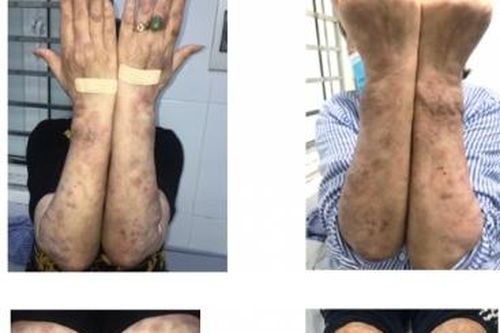 Hà Nội: Người phụ nữ mắc phong thể nhiều vi khuẩn giống Lupus ban đỏ