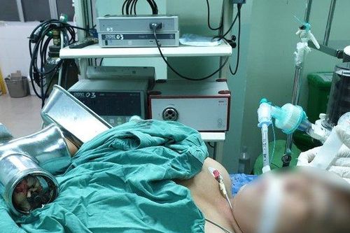 Xay cá làm chả, người phụ nữ bị máy cuốn dập nát bàn tay