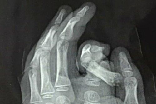 Nghịch máy giặt, bé trai 6 tuổi bị đứt rời ngón trỏ và chưa thể nối