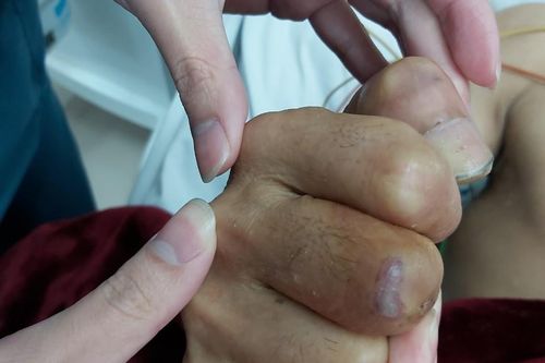 Người đàn ông nguy kịch vì vết thương nhỏ ở tay