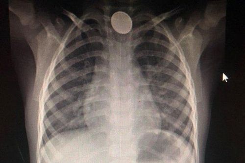 Cấp cứu kịp thời bé trai 4 tuổi nuốt cục pin gây bỏng thực quản