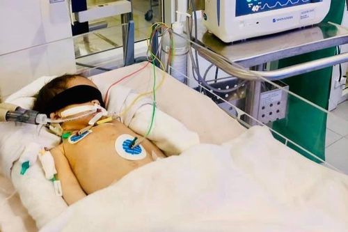 Bé sơ sinh bị chảy máu não