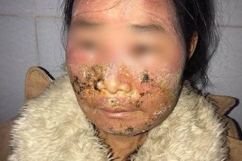 Bôi kem để làm đẹp không ngờ dị ứng lở loét