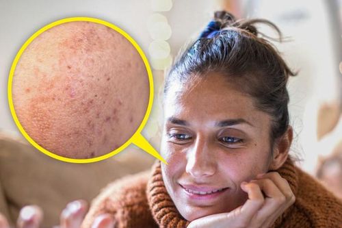 7 nguyên nhân khiến mặt bạn xuất hiện tàn nhang