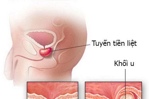 Dấu hiệu của ung thư tiền liệt tuyến là gì?