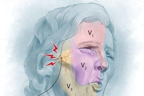 Đau dây thần kinh số V - Cơn đau dữ dội như 'chết đi sống lại'