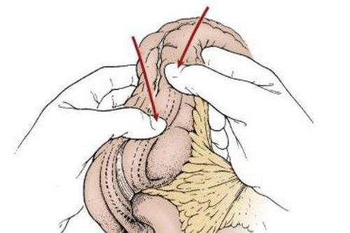 Người lớn cũng có thể bị lồng ruột