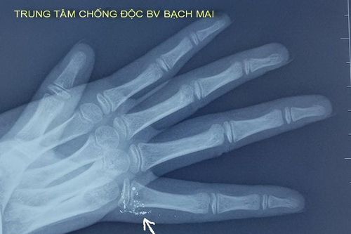 Lần đầu tiếp nhận bệnh nhi bị nhiễm độc thủy ngân từ nhiệt kế
