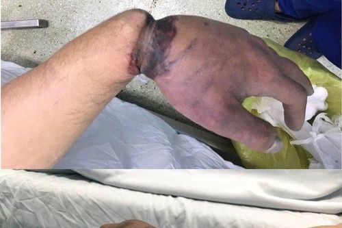 Nam công nhân suýt đứt lìa bàn tay được cứu sống kịp thời