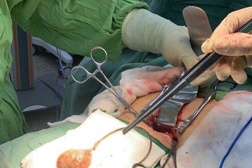 Lấy viên sỏi bằng quả trứng trong cơ thể cụ bà quên ống sonde 9 năm