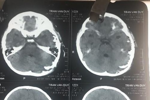 Bệnh viện Nhi Thanh Hóa điều trị thành công bệnh nhân bị vết thương sọ não hở do chó cắn