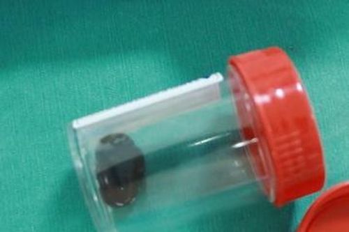 Người đàn ông bị ho ra máu do vắt chui vào khí quản