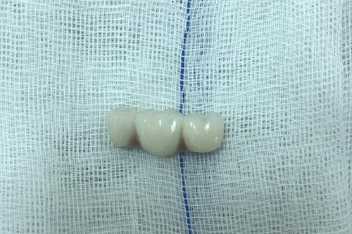 Lấy thành công 4 chiếc răng giả trong dạ dày chỉ trong 3 phút