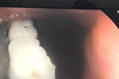 Nội soi can thiệp lấy 4 chiếc răng giả 'lạc' vào dạ dày