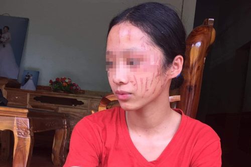 Nghệ An: 'Bảo vệ' em gái, nữ sinh lớp 8 bị cào sưng đỏ mặt