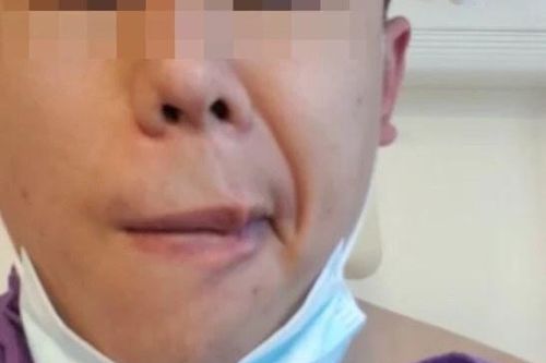 Người đàn ông liệt mặt sau khi được tiêm vaccine của Trung Quốc