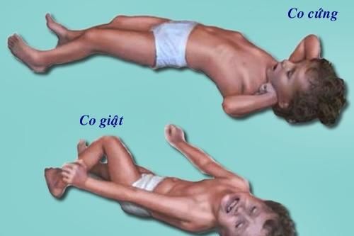 Không dùng thuốc trị động kinh cho trẻ dưới 5 tuổi