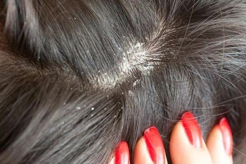 4 công thức trị gàu đơn giản nhất hiện nay