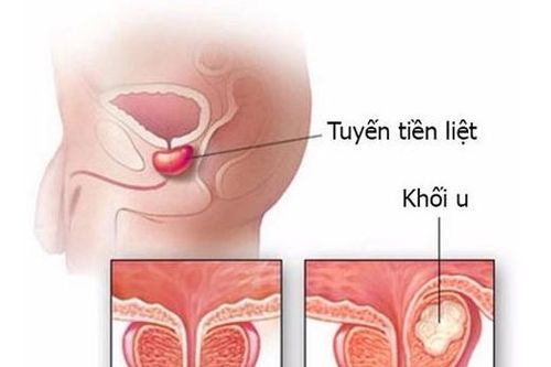 Nam giới có nguy cơ cao mắc top 10 căn bệnh ung thư này