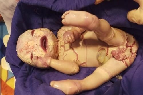 Xót xa, em bé khi chào đời có lớp sừng trắng, nứt nẻ toàn thân