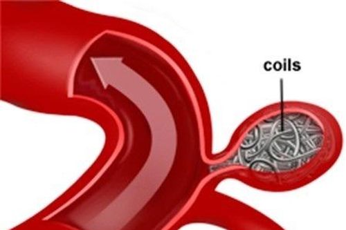 Nút coils cứu sống nữ bệnh nhân vỡ phình mạch não