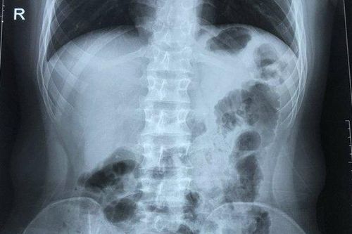 Hi hữu chàng trai 17 tuổi bị viêm ruột thừa có trái tim nằm bên phải