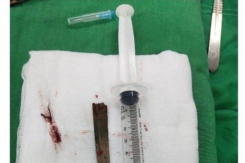 Thanh niên mang cả mũi dao cắm sâu vào lưng đến bệnh viện