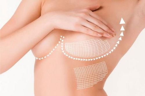 Nâng ngực, coi chừng bị biến chứng nặng nề