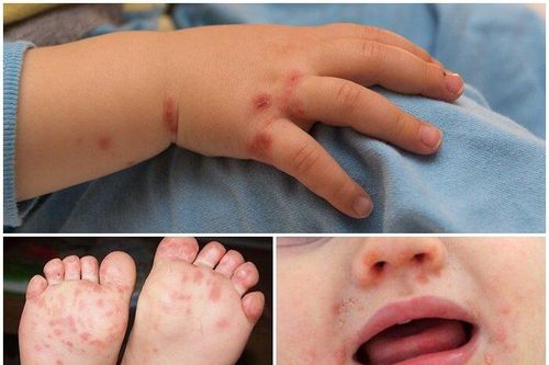 Gia tăng các ca tay chân miệng tại Hà Nội