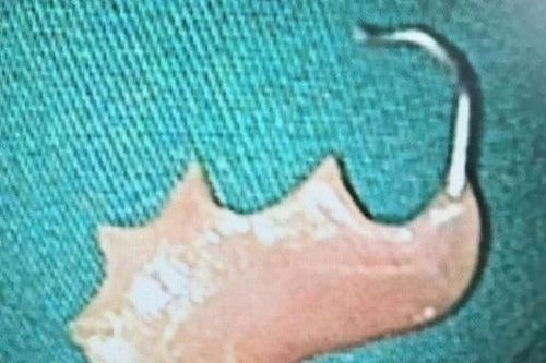 Bị hóc dị vật đừng cố chữa bằng mẹo