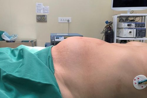 Bị khối u nặng 4 kg chèn ép nội tạng vì tự chữa u xơ tử cung bằng thuốc Nam