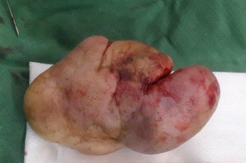 Giải thoát cho người đàn ông 'đeo' khối u to như nắm tay ở tai