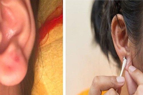 Bấm lỗ tai, thiếu nữ 17 tuổi hoại tử vành tai