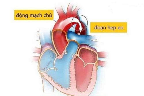 Hẹp eo động mạch chủ: Tiên lượng tốt nếu chẩn đoán sớm