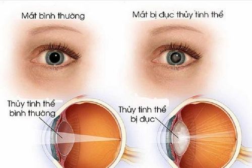 Mắt mờ đột ngột, coi chừng mất thị lực vĩnh viễn