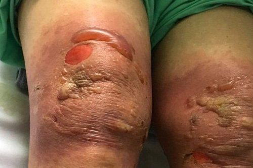 Phỏng rộp, sưng nề 2 khớp gối vì bó lá thuốc xào chung với giấm