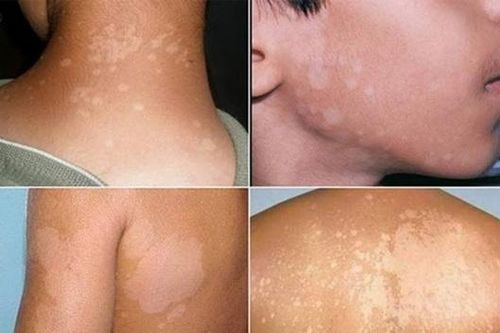 Lang ben, bệnh phổ biến ở vùng nhiệt đới nóng ẩm