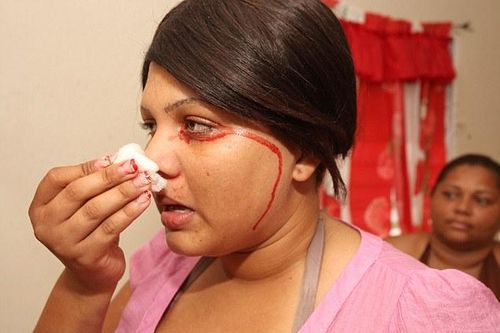 Căn bệnh kỳ lạ biến nước mắt và mồ hôi thành máu