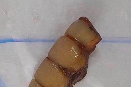 30 phút 'truy tìm' răng giả 'lạc' vào phế quản