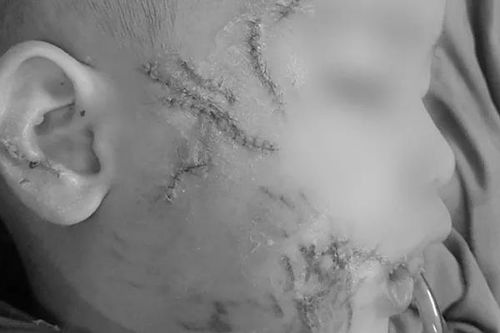 Thương tâm bé trai 3 tuổi bị chó cắn nát mặt