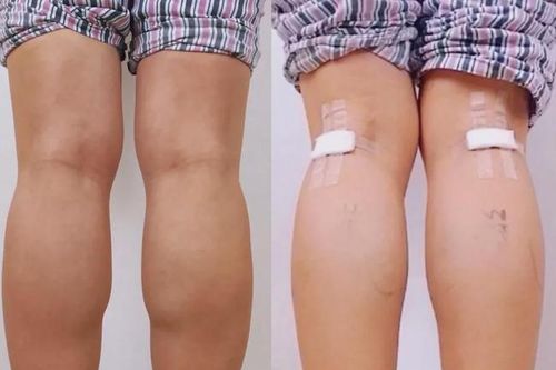 Làm đẹp kinh dị: Cắt dây thần kinh để có bắp chân thon gọn