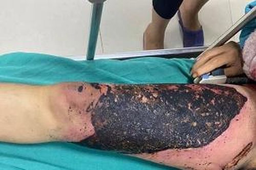Nhiễm trùng nặng do tự đắp thuốc lá chữa bỏng